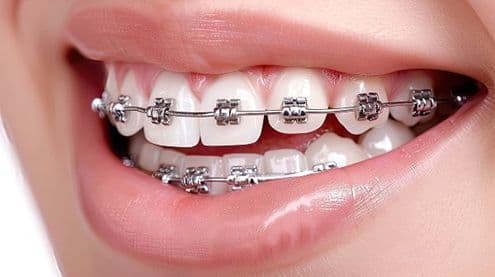 Galleria apparecchi dentali di Aura Clinic - Aura Clinic Vlora