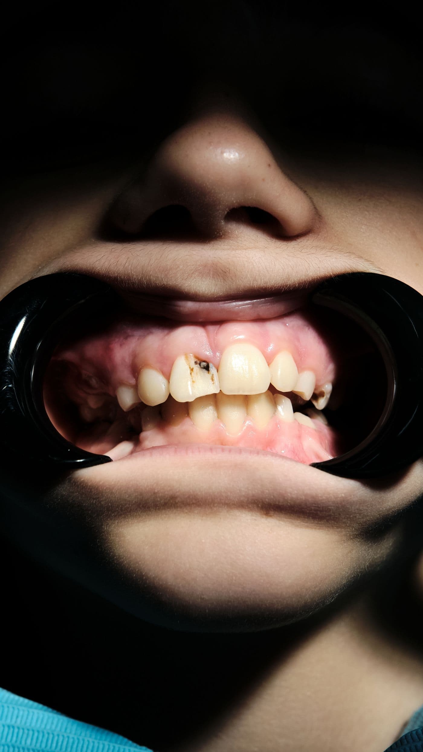 Pediatric dentistry gallery from Aura Clinic - Aura Clinic Vlora