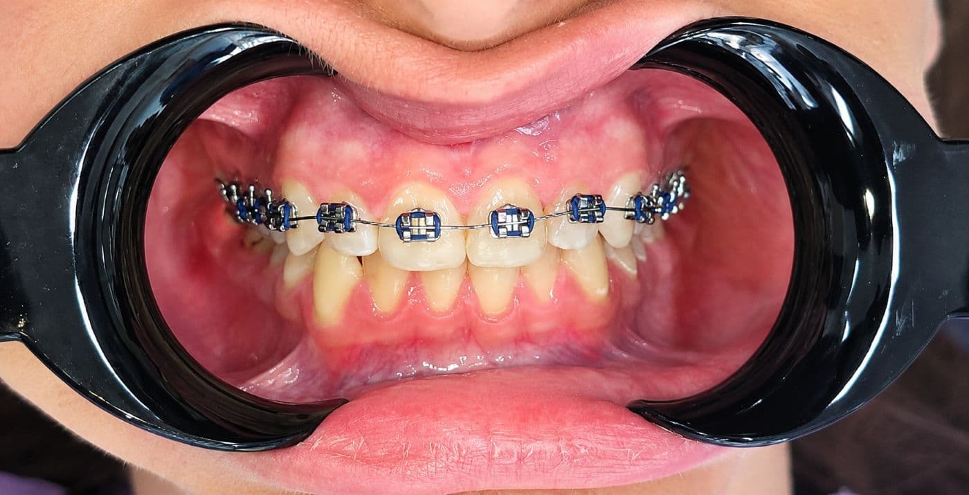 Aparatet dentare në Vlorë Shqipëri në Aura Clinic