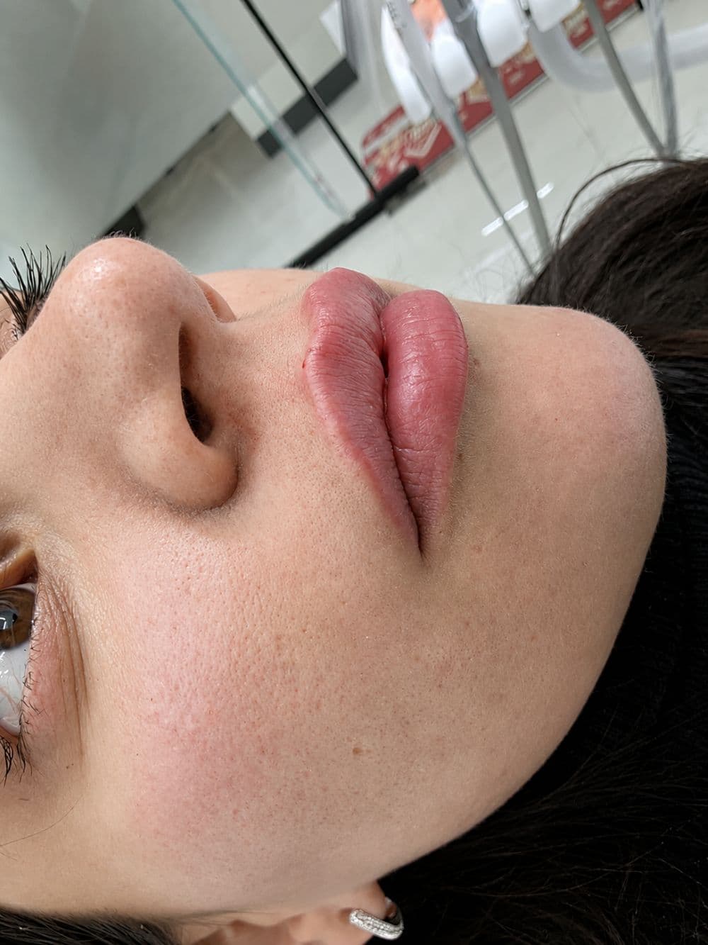 Filler dermal