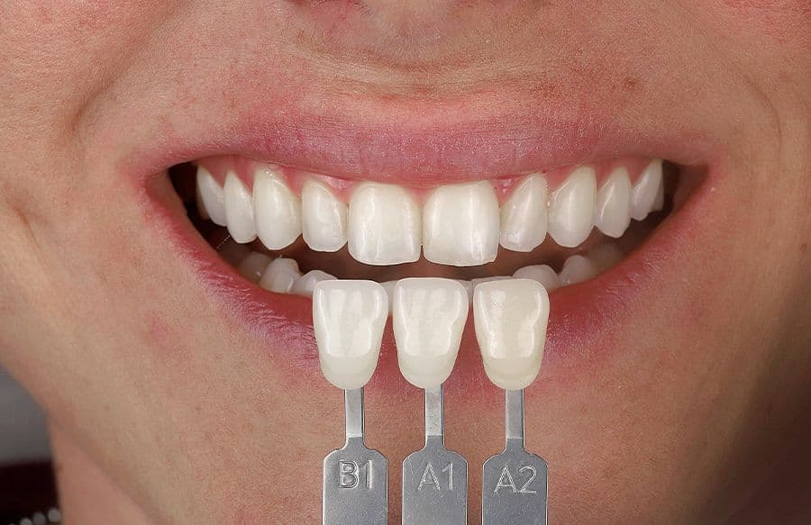 Faseta dentare në Vlorë Shqipëri në Aura Clinic me estetikë dentare moderne