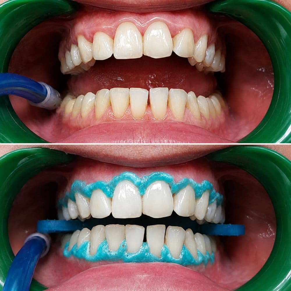 TERAPI KONSERVATIVE / ENDODONTI