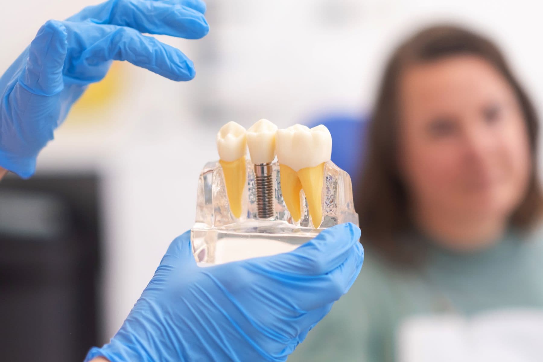 Implantet dentare në Vlorë Shqipëri në Aura Clinic me implantologji moderne